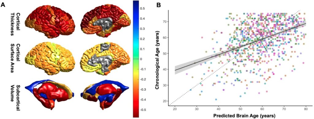 Brain age associations in people with stroke. (A) Visualization of correlations between predicted brain age and region-of-interest measurements. Warmer colors indicate stronger negative associations (e.g., larger volumes associated with younger predicted brain age), while cooler colors indicate stronger positive associations (e.g., larger ventricles associated with older predicted brain age). (B) Chronological age by predicted brain age across the entire sample. (Photo credit: USC Stevens INI, Neurology)