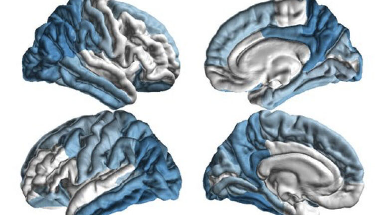 USC leads global consortium of researchers for NIH funded study on Parkinson’s disease